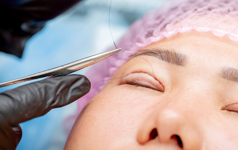 Cắt mí mắt an toàn tại Thẩm mỹ Á Đông TP.HCM