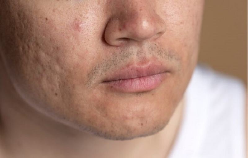 Những sai lầm khi trị sẹo rỗ khiến không hiệu quả - Thẩm mỹ Á Đông